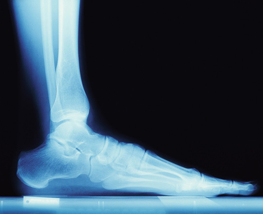 Röntgenbild Fuß